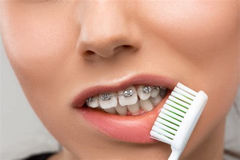 braces deep throat|The Stages of Braces: What To Expect .